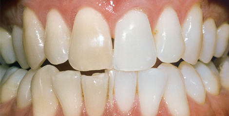 Zahnarzt Plauen | Praxis Kühn - Bleaching | Vorher-Nachher Bsp. 1