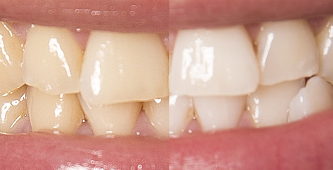 Zahnarzt Plauen | Praxis Kühn - Bleaching | Vorher-Nachher Bsp. 2